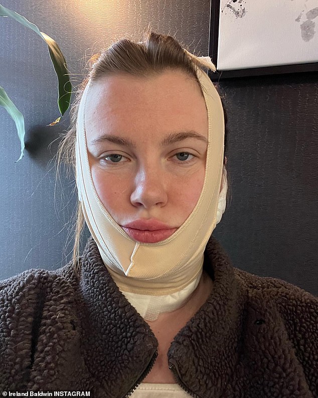 The Healing: Dalam video Instagram baru yang diposting pada Selasa sore, model berusia 26 tahun itu menjelaskan bahwa FaceTite adalah prosedur di kantor minimal invasif selama satu jam yang bahkan tidak memerlukan anestesi.